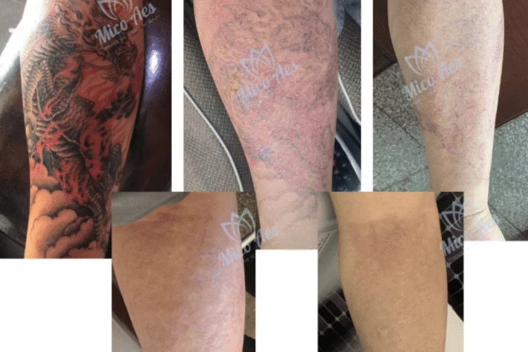 Professional Training Guide for Laser Tattoo Removal Operators Mastering PicoWay® Techniques and Protocols